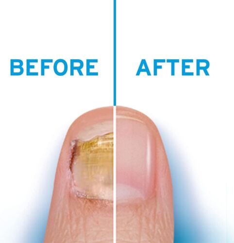 Excilor Treatment for Fungal Nail Infection