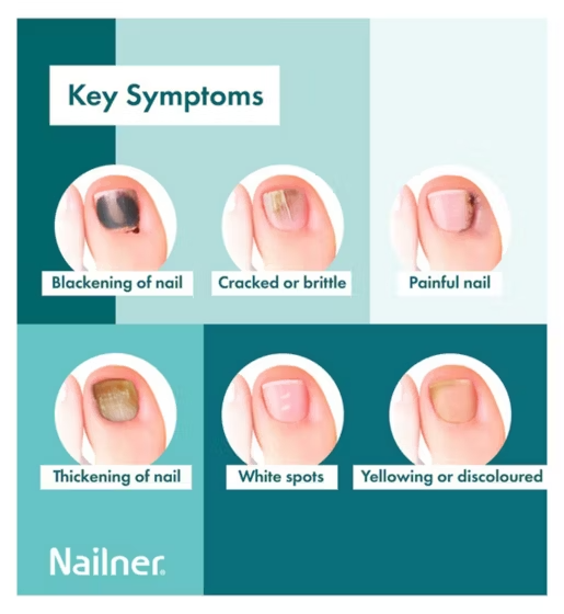 Nailner Active Cover Nail Fungus Treatment